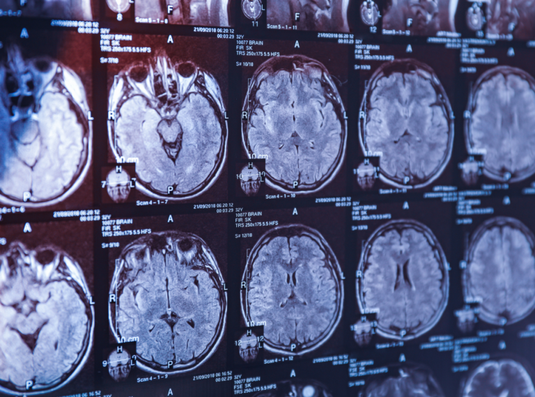 brain scans
